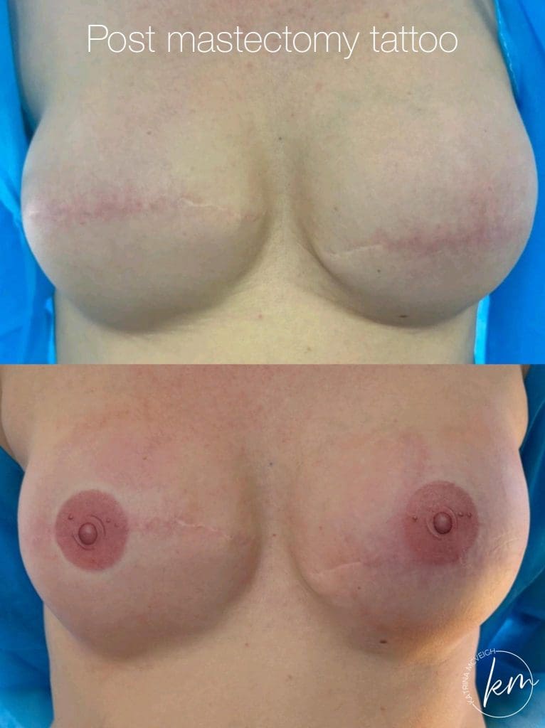 Post Mastectomy 3D Areola replacement tattoos by Katrina McVeigh PMU - Award Winning Permanent Makeup Artist - Specialising in powder brows, lip blushing, scar camouflage, 3D areola replacement tattoos, and MM tattoo removal