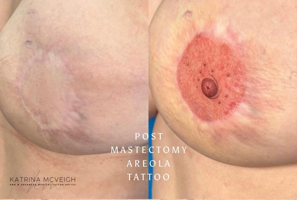 3D Areola Replacement Tattoos by Katrina McVeigh, Award Winning Permanent Makeup and Advanced Medical Tattoo Artist Northern Ireland